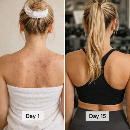 BacneErase™ Body Cleanser