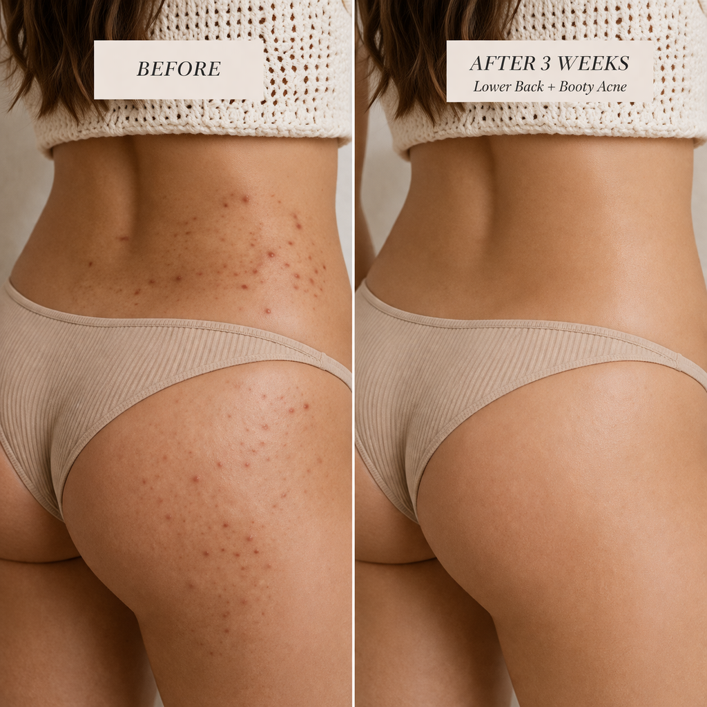 BacneErase™ Body Cleanser